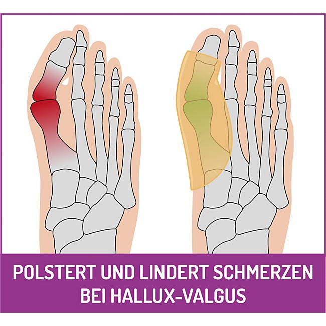 babybutt FußGut Hallux Überbeinschutz 1 Paar Günstig kaufen
